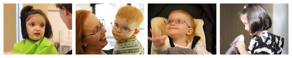 Fire bilder av to ulike barn med Mowat-Wilsons syndrom