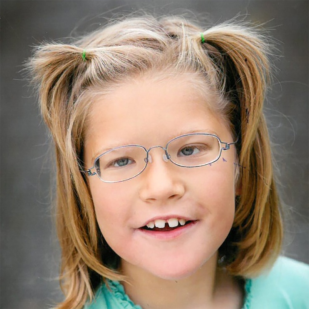 Pitt-Hopkins syndrom Jente med Pitt-Hopkins
